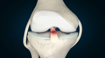ACL Tear